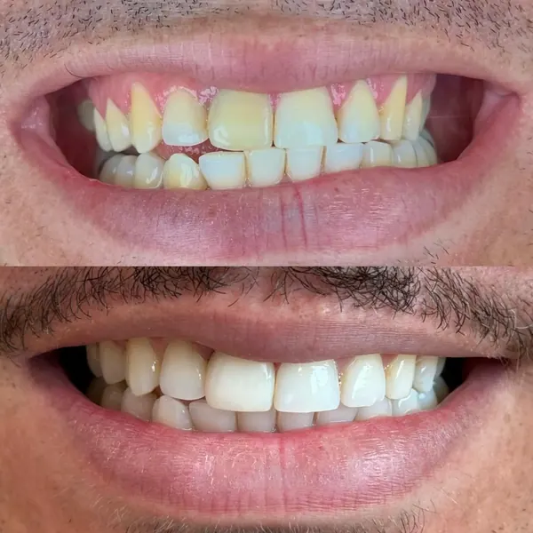 Antes e depois: Clareamento de consultório e faceta em resina