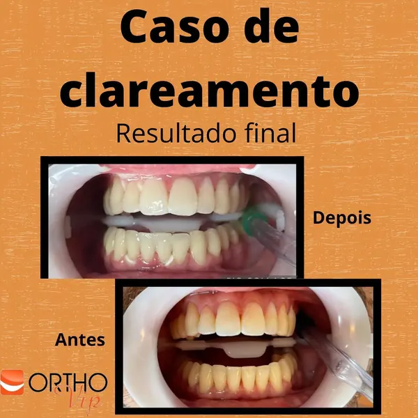 Antes e depois: Clareamento de consultório a laser