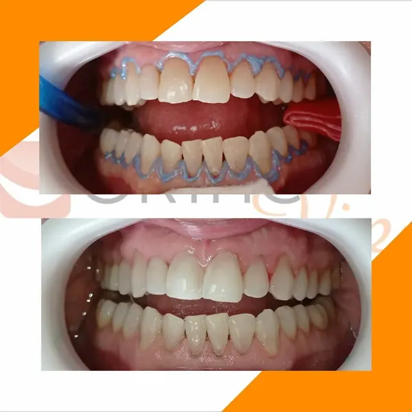 Antes e depois: Clareamento de consultório