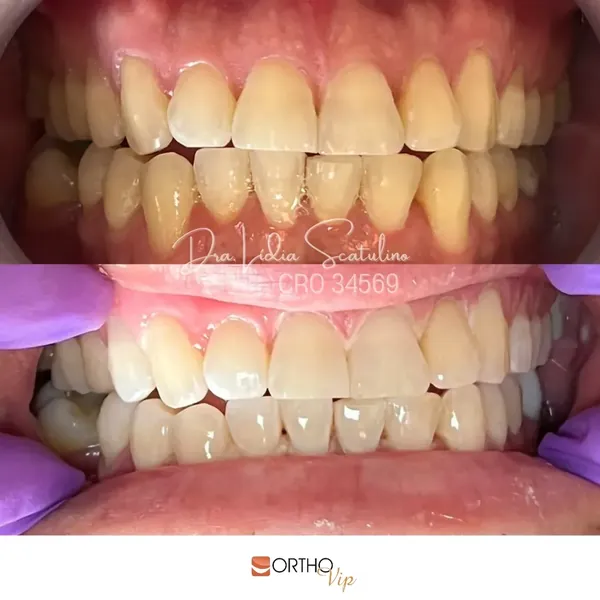 Antes e depois: Clareamento a laser: primeira sessão