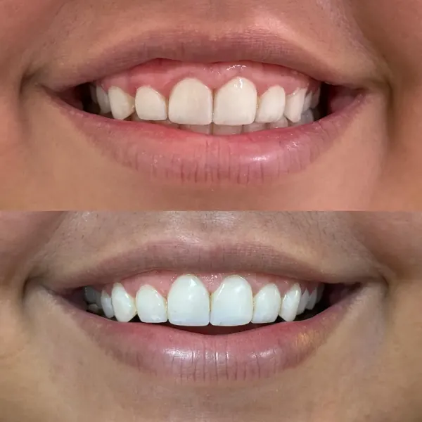 Antes e depois: Gengivoplastia para reduzir a gengiva aparente