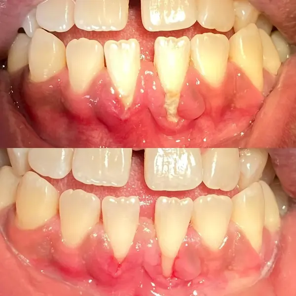 Antes e depois: Tratamento periodontal: primeira sessão