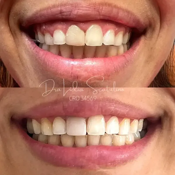 Antes e depois: Sorriso gengival: toxina botulínica, gengivoplastia e lente de resina