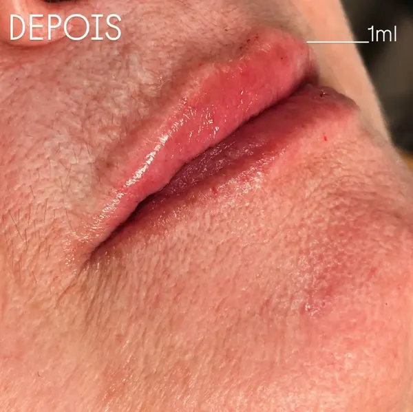 Depois: Preenchimento labial com ácido hialurônico (1 ml)