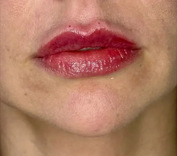 Depois: Preenchimento labial: contorno e definição