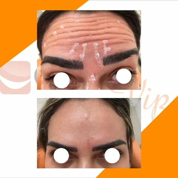 Antes e depois: Toxina botulínica na testa, glabela e região dos olhos, imagem 1 de 3