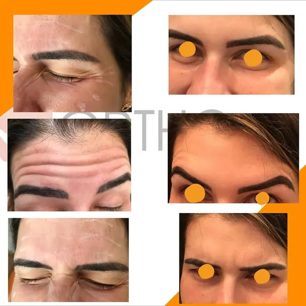 Antes e depois: Toxina botulínica: resultado após 1 mês