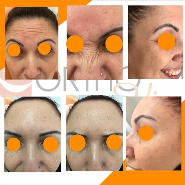 Antes e depois: Toxina botulínica para linhas de expressão