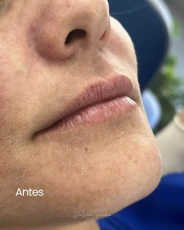 Antes: Preenchimento labial: contorno e volume