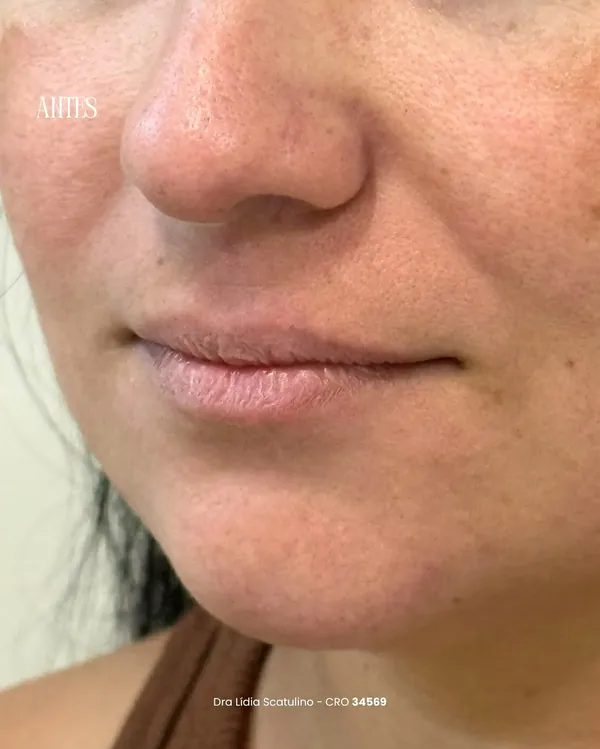 Antes: Preenchimento labial e projeção do queixo