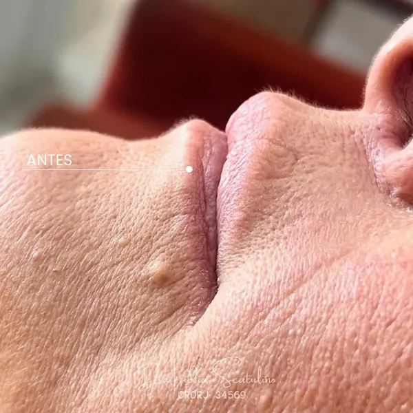 Antes: Preenchimento labial e das linhas acima do lábio