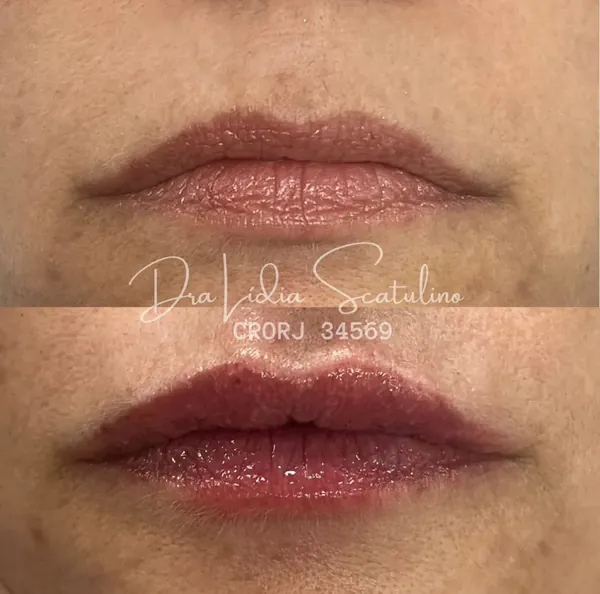 Antes e depois: Preenchimento labial com aspecto natural
