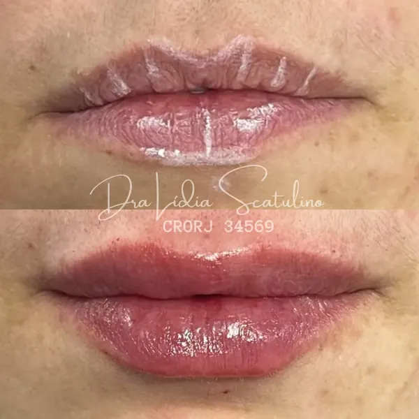 Antes e depois: Preenchimento labial: proporção entre os lábios