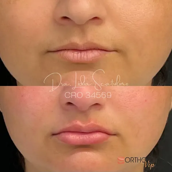Antes e depois: Preenchimento labial sutil