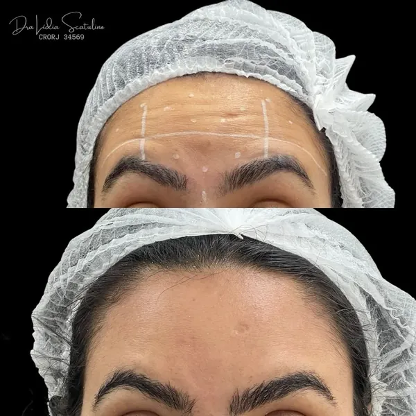 Antes e depois: Toxina botulínica na testa e na glabela, imagem 1 de 2