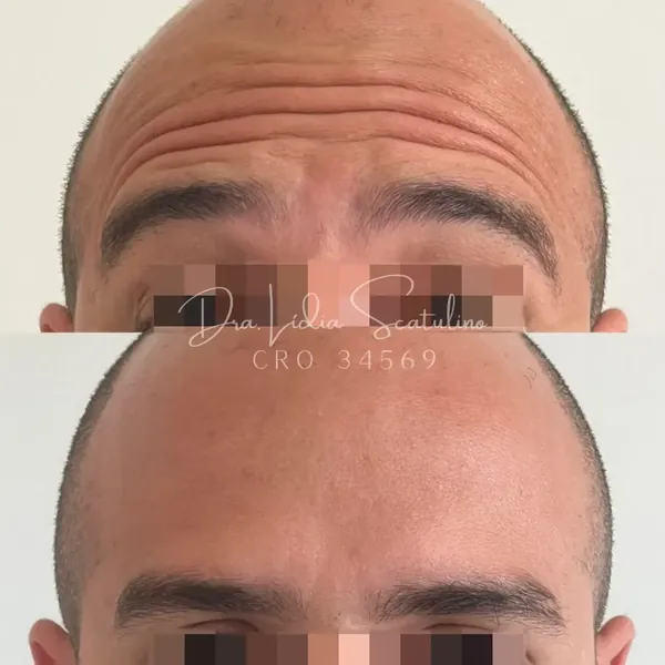 Antes e depois: Toxina botulínica em paciente masculino, imagem 1 de 3
