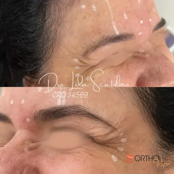 Antes e depois: Toxina botulínica na região dos olhos, imagem 1 de 2