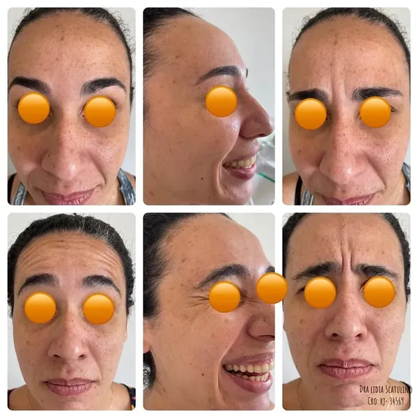 Antes e depois: Toxina botulínica na testa e ao redor dos olhos