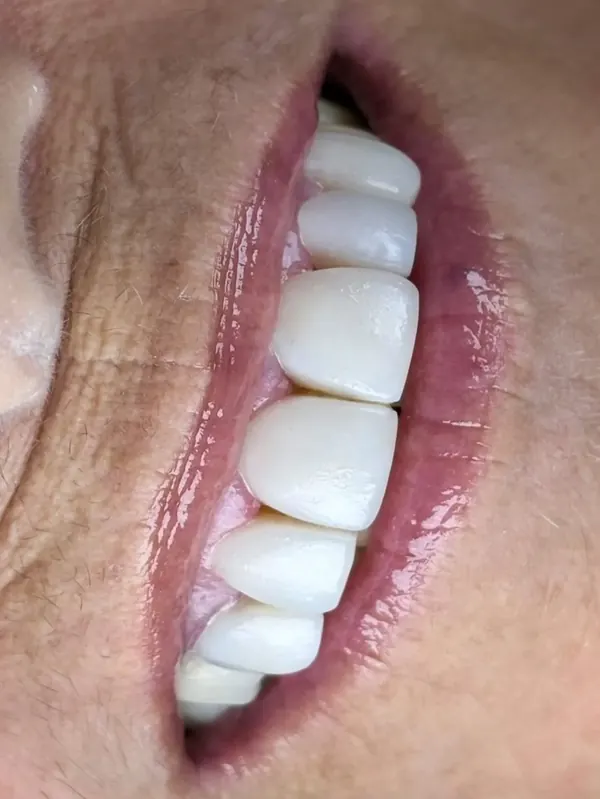 Depois: Facetas em resina: forma, cor e brilho