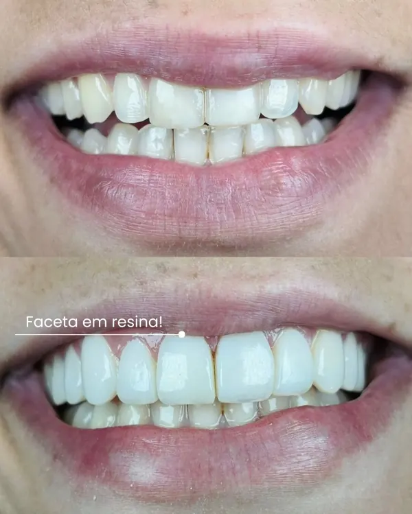 Antes e depois: Facetas em resina