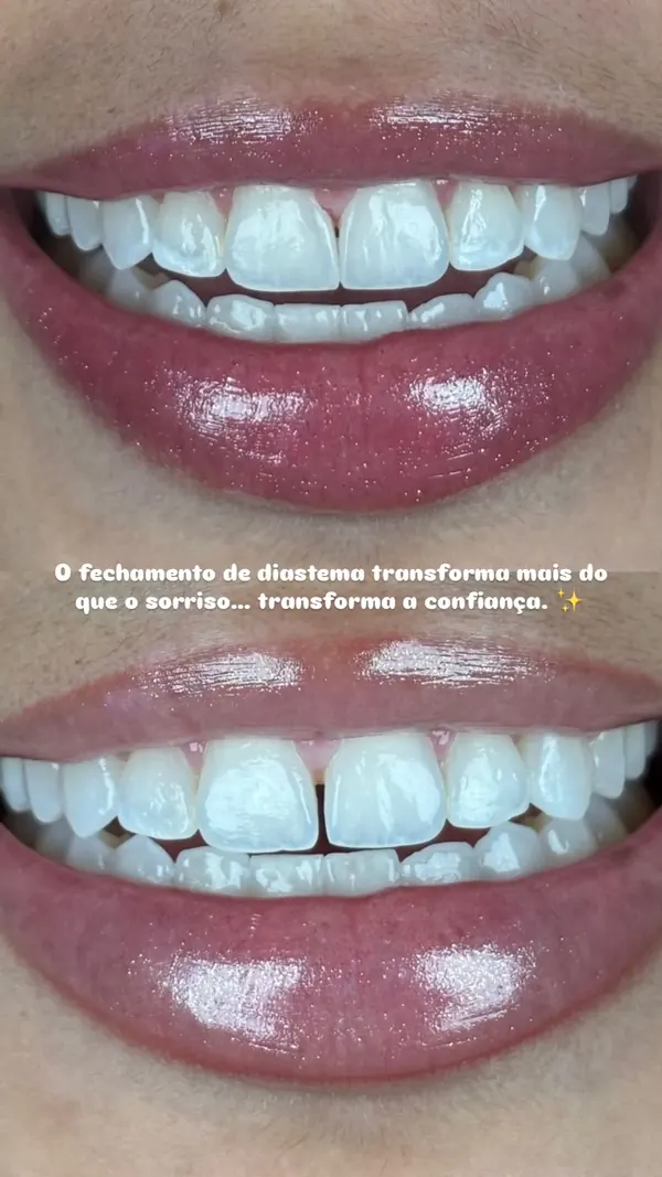 Antes e depois: Fechamento de diastema com resina