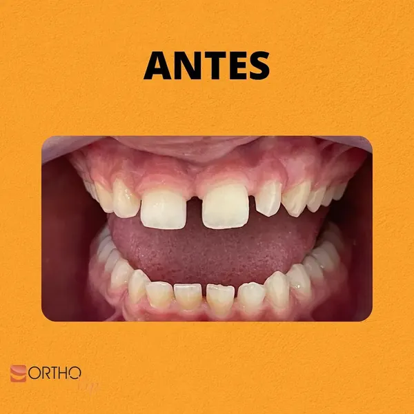 Antes: Lentes de contato em resina para fechar diastemas