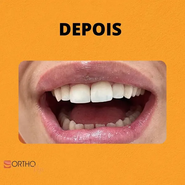 Depois: Lentes de contato em resina para fechar diastemas