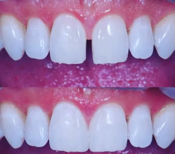 Antes e depois: Fechamento de diastema com resina composta