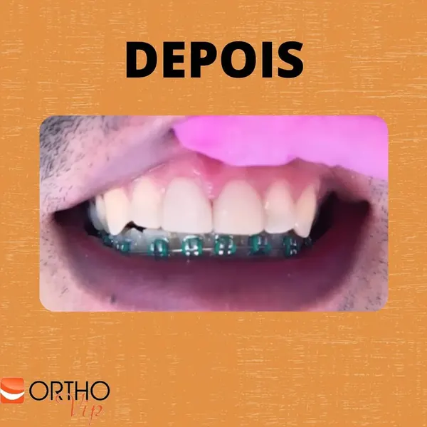 Depois: Lente de contato em dente escurecido após canal