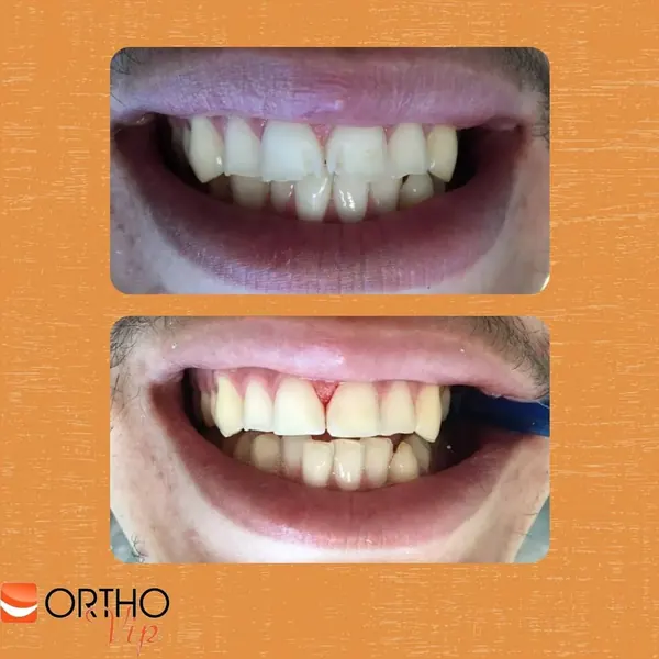 Antes e depois: Facetas de resina nos incisivos centrais