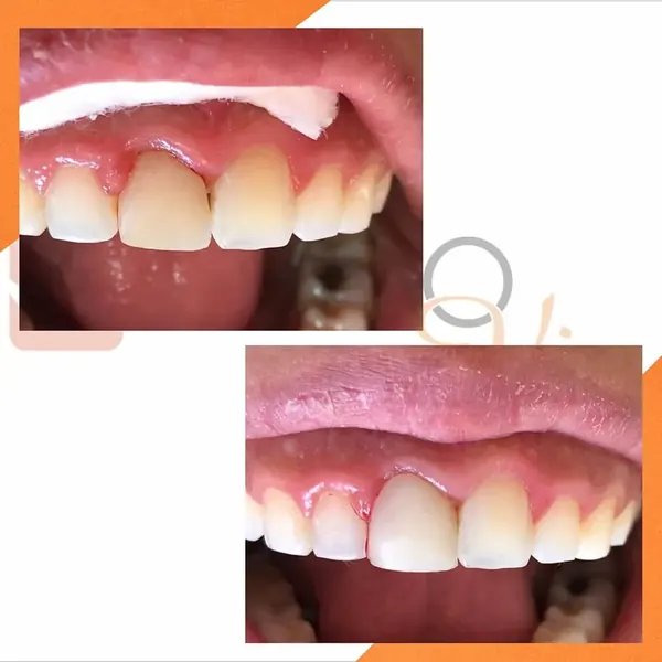 Antes e depois: Clareamento interno e lente de contato em dente com canal