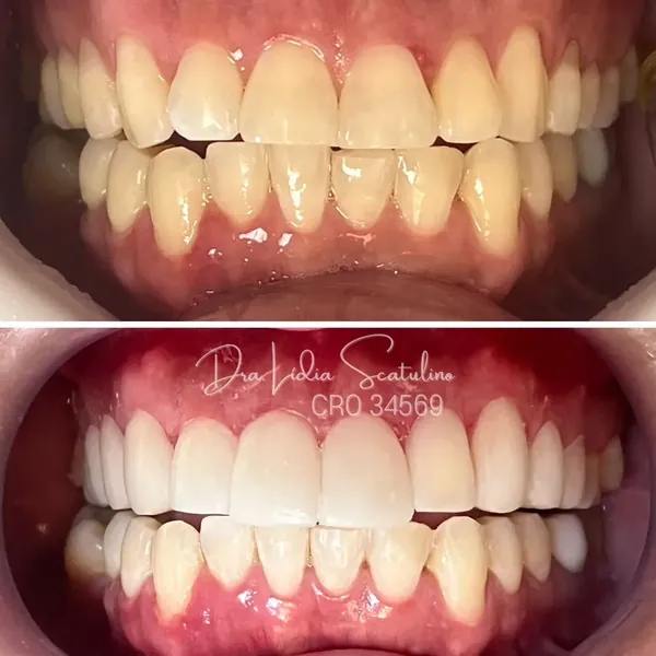 Antes e depois: Lentes de contato em resina nos dentes superiores
