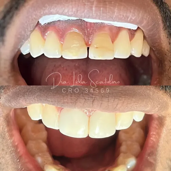 Antes e depois: Lentes de resina nos incisivos centrais