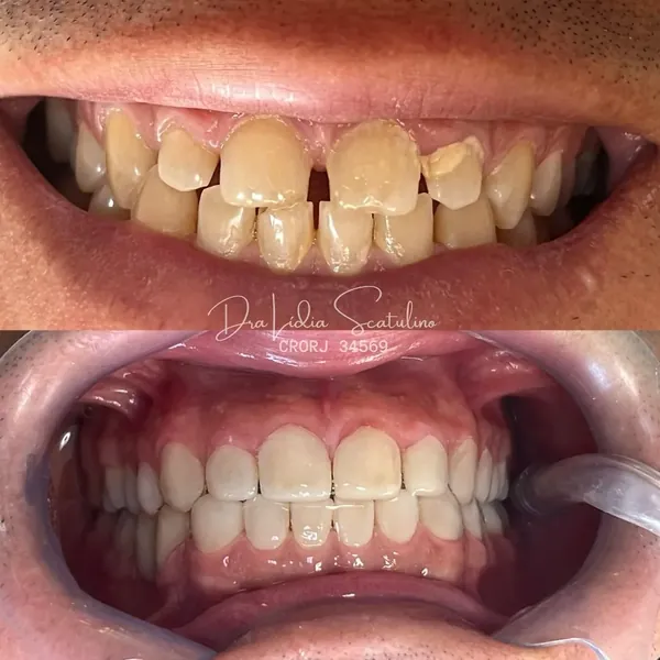 Antes e depois: Fechamento de diastemas com lentes de resina
