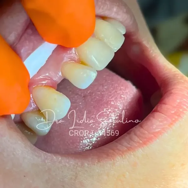 Antes: Fechamento de diastema lateral com resina