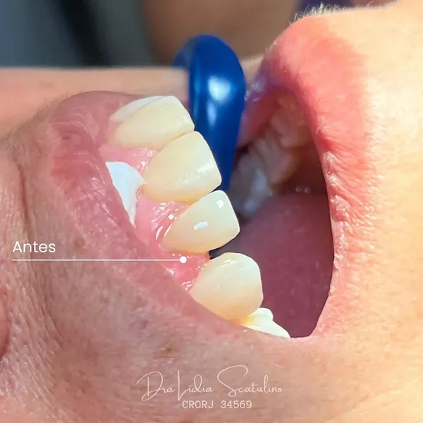 Antes: Fechamento de diastema com resina, vista lateral
