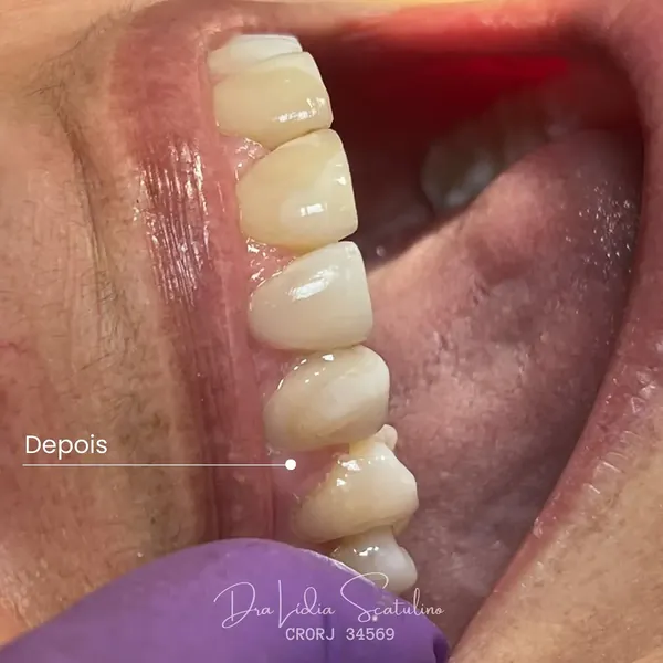 Depois: Fechamento de diastema com resina, vista lateral