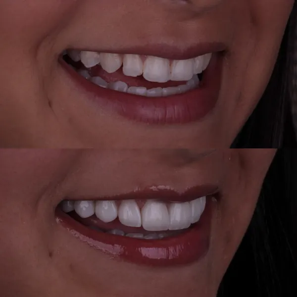 Antes e depois: Lentes de contato dental
