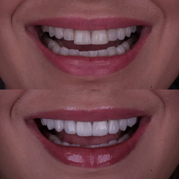 Antes e depois: Lentes de contato dental