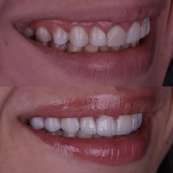 Antes e depois: Lentes de contato dental