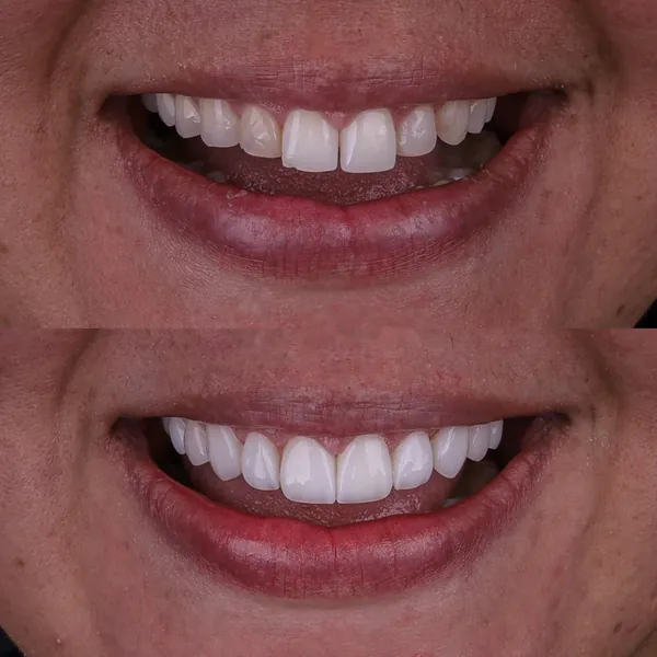 Antes e depois: Lentes de contato dental