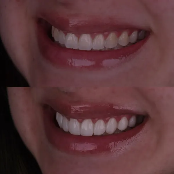 Antes e depois: Lentes de contato dental