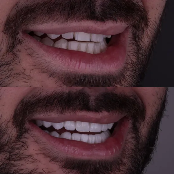 Antes e depois: Lentes de contato dental
