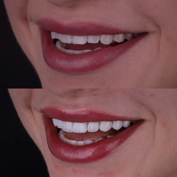 Antes e depois: Lentes de contato dental
