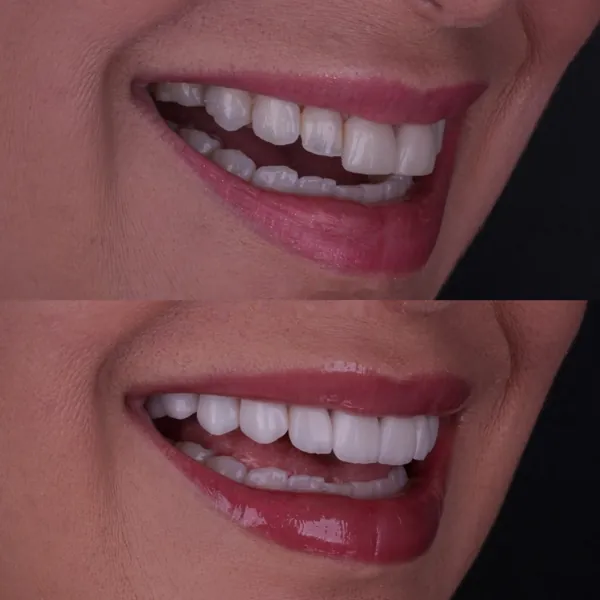 Antes e depois: Lentes de contato dental