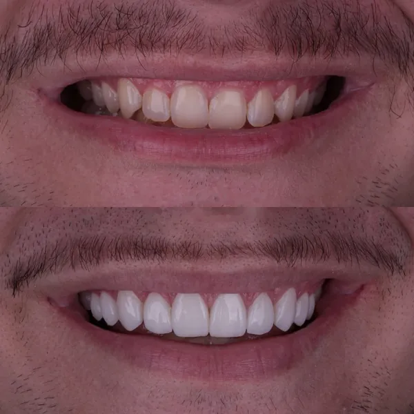 Antes e depois: Lentes de contato dental