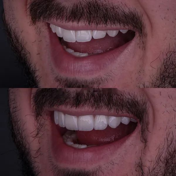 Antes e depois: Lentes de contato dental