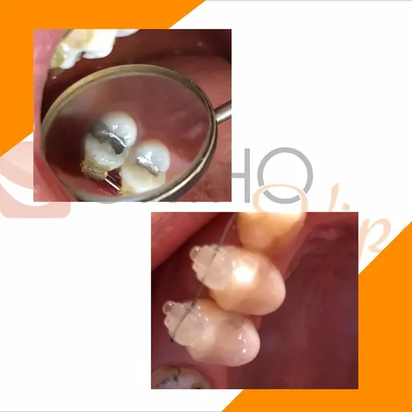 Antes e depois: Troca de restauração de amálgama por resina