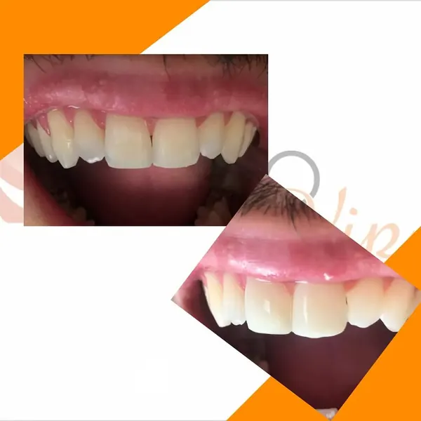 Antes e depois: Tratamento de manchas de fluorose