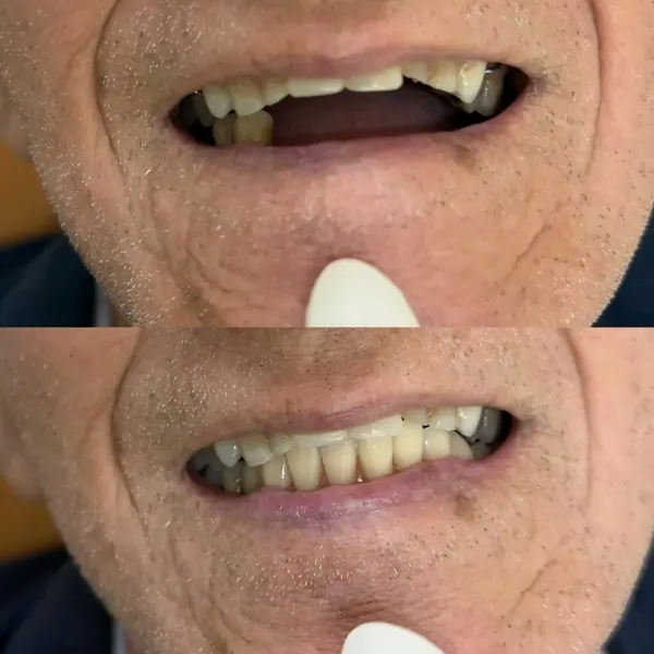 Antes e depois: Reabilitação de dentes ausentes com prótese